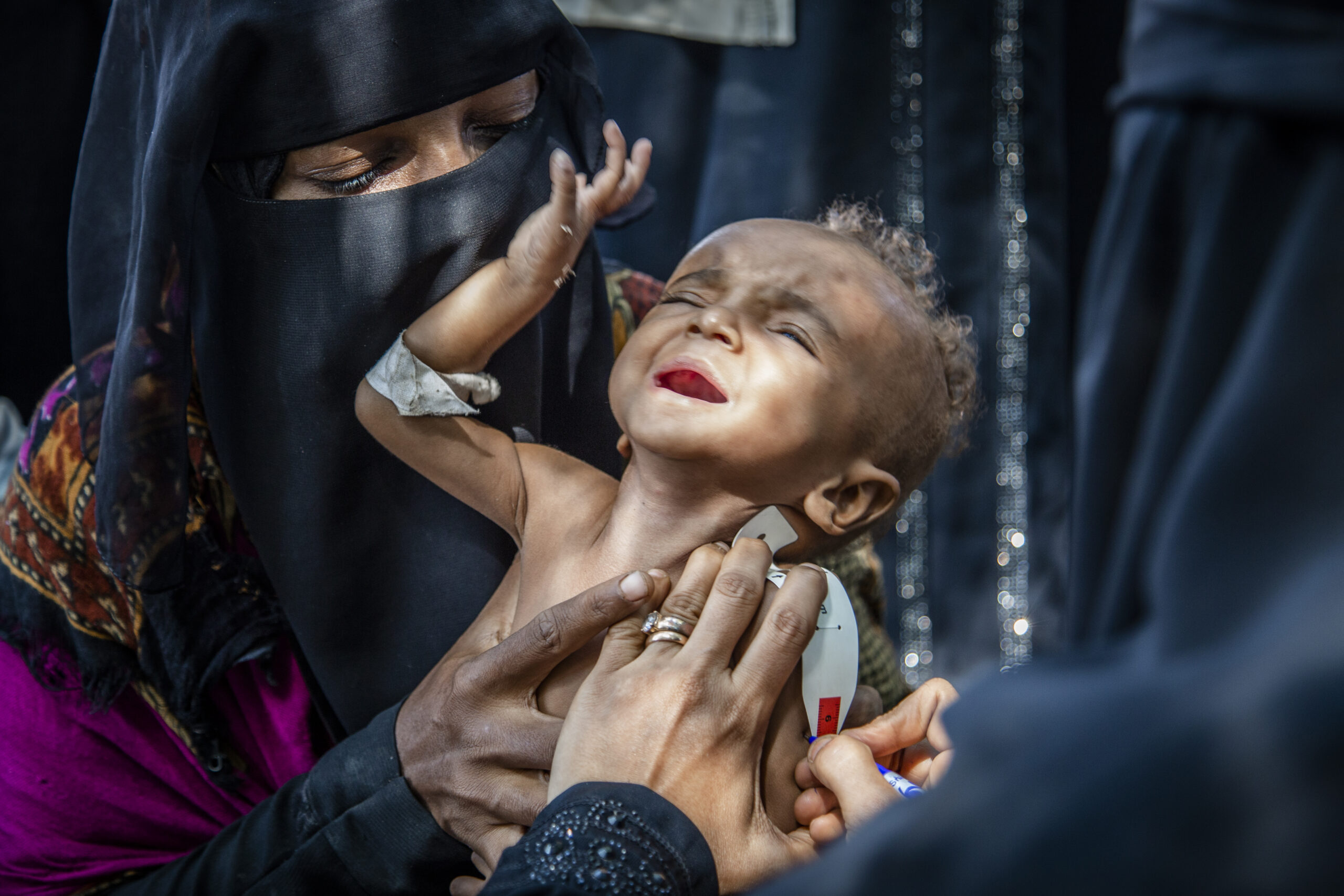 Humanitarian Advisors malnutrition in Yemen